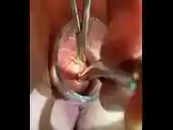 Gyno sound into uterus