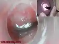 Endoscope with camera is inserted into the cervix to see inside